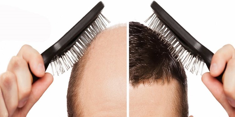 Przeszczep włosów-włosy-łysienie-trwałość-wyniki